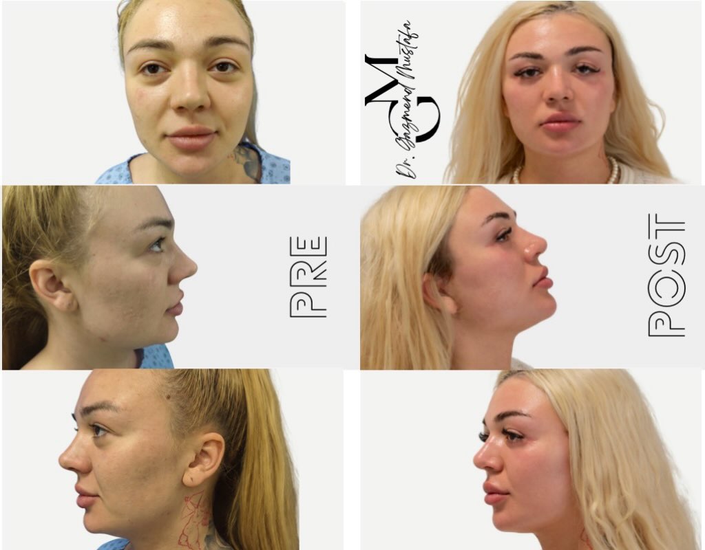 Prima e dopo il Deep Extended Face Lift: confronto frontale e di profilo della stessa paziente