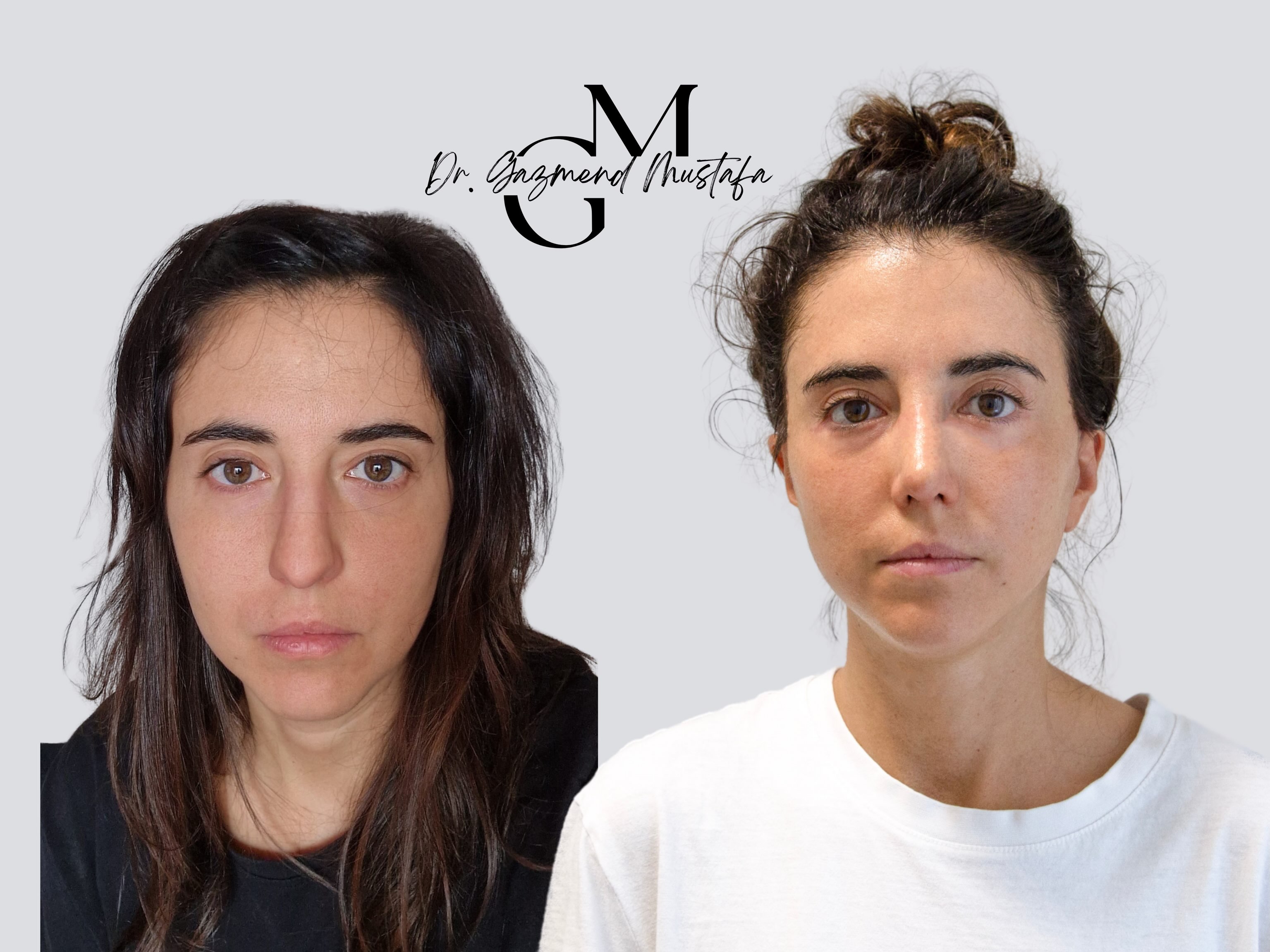 Prima e dopo il Deep Extended Face Lift: confronto frontale della stessa paziente