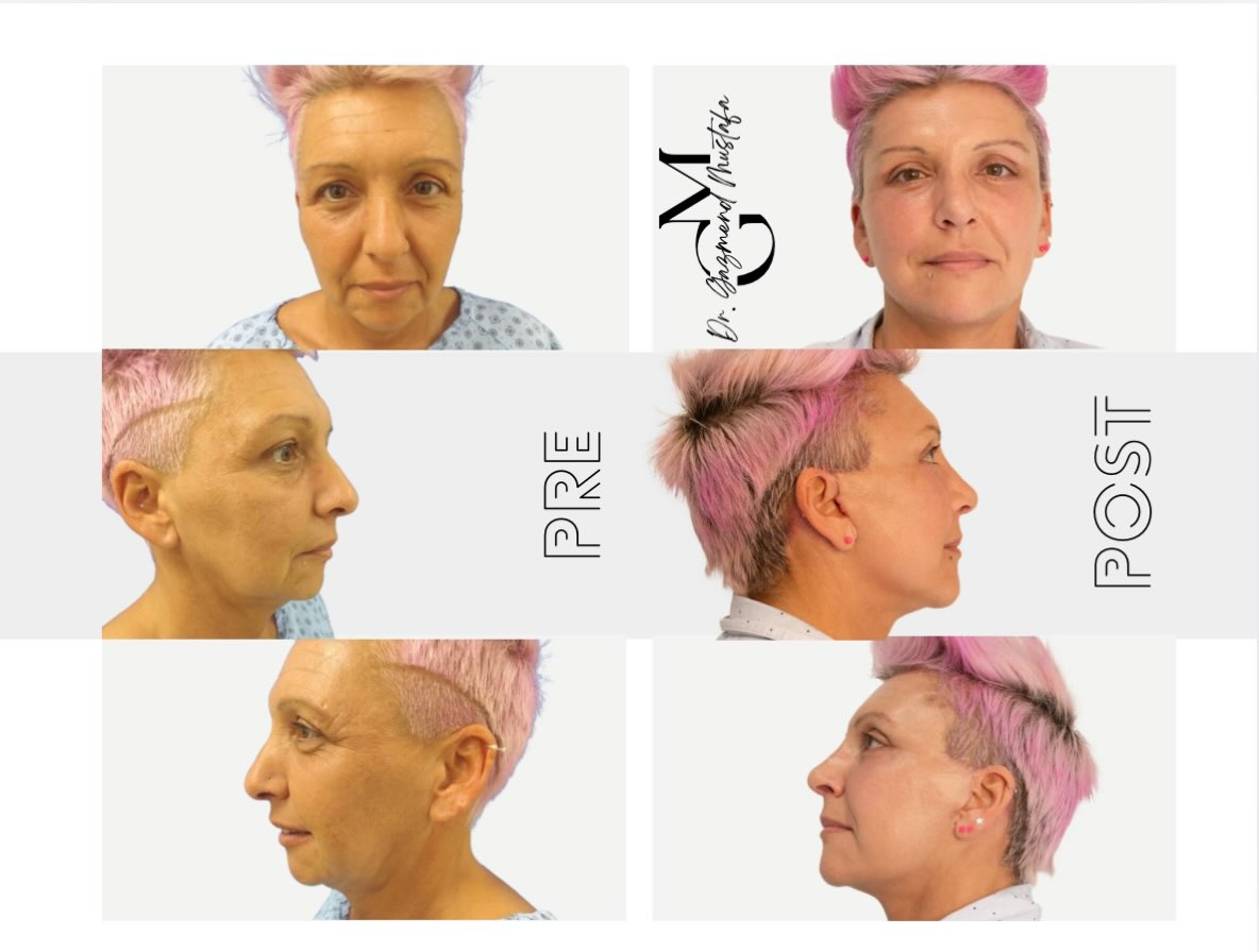 Prima e dopo il Deep Extended Face Lift: confronto frontale e di profilo della stessa paziente
