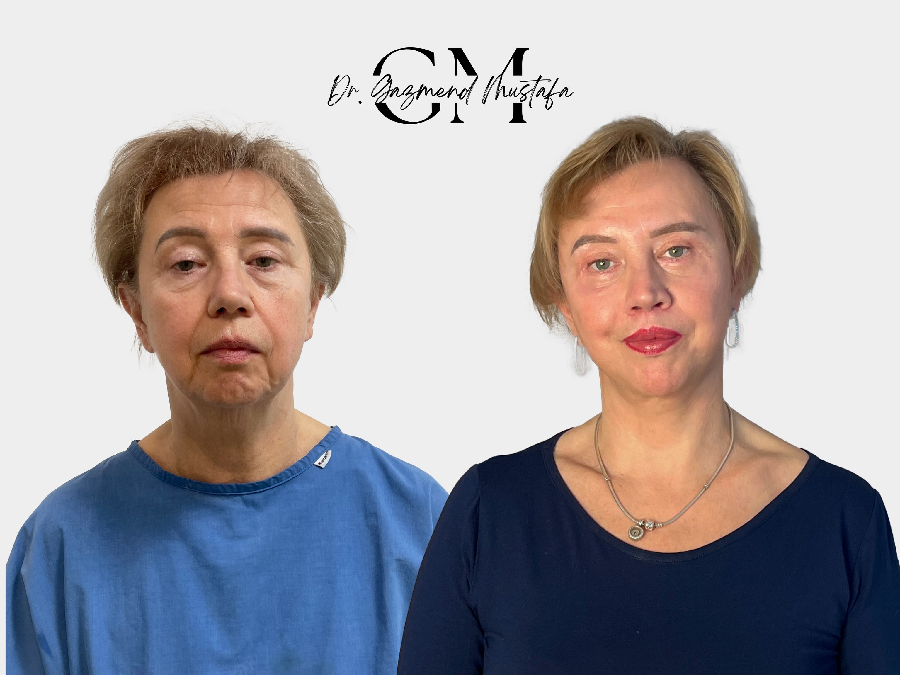 Prima e dopo il Deep Extended Face Lift: confronto frontale della paziente Viktoriya